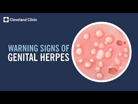 herpes in penus|Understanding Herpes on the Penis Head: Symptoms,。